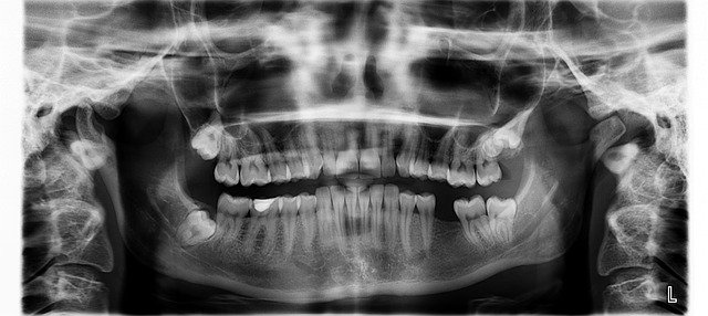 rentgen zubů